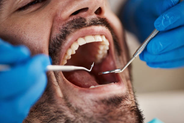 Best Emergency Root Canal Treatment in New Albany, IN